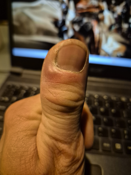 beginnend stadium paronychia